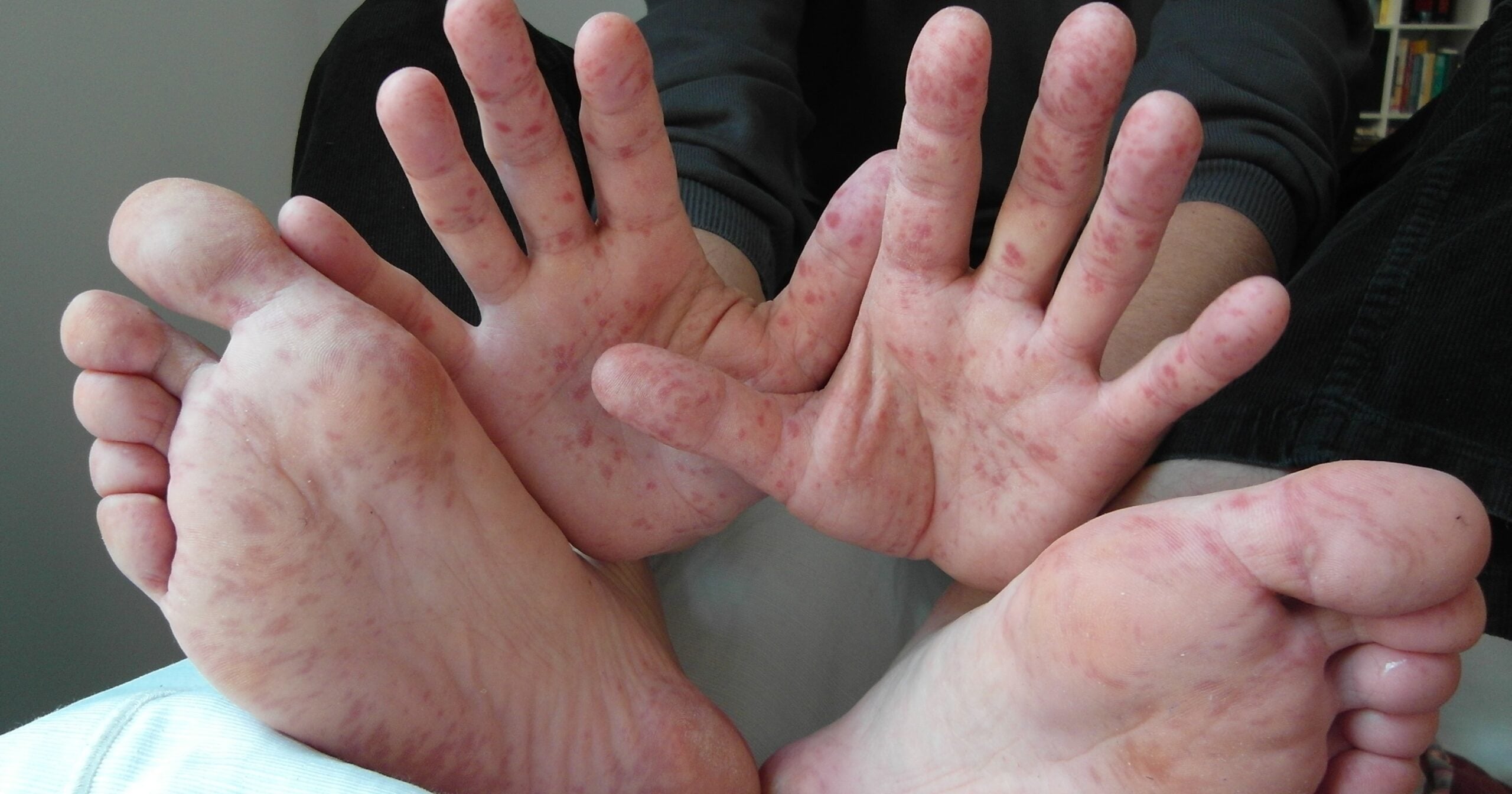 Hdmf Rashes Precautions Parents Should Take Now That There’s A HFMD Outbreak In ...