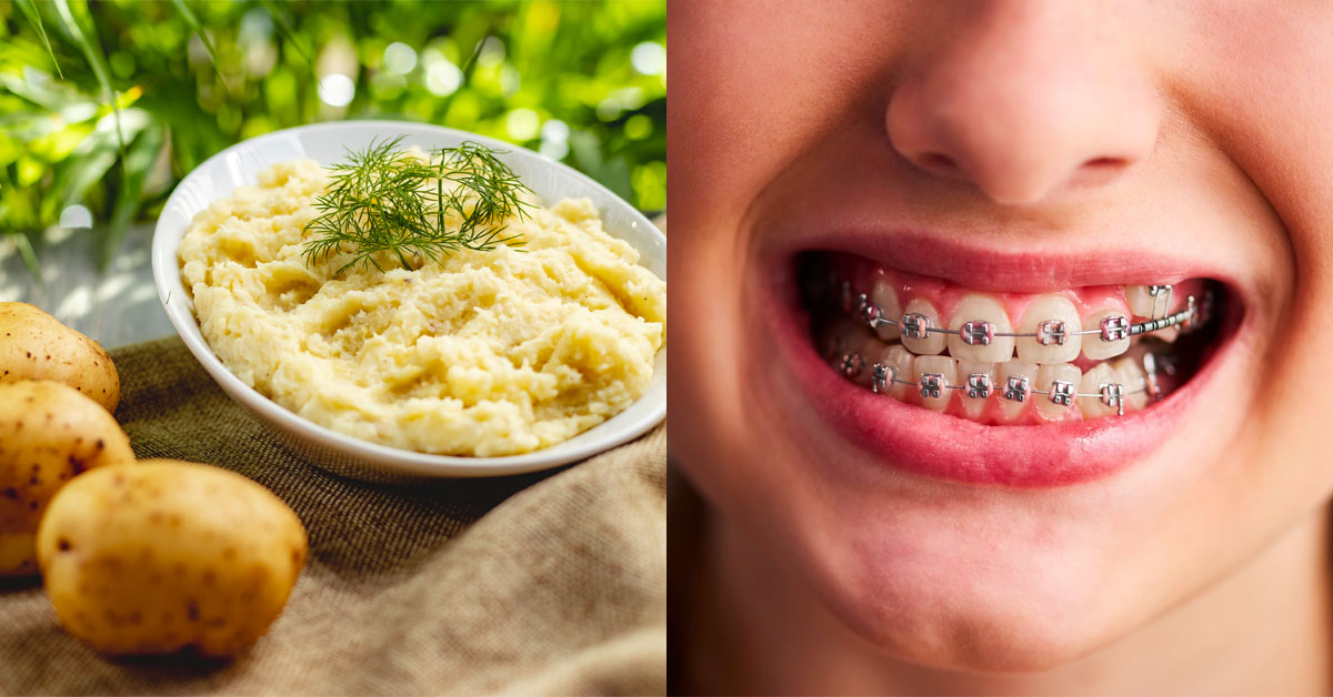 9 Best Soft Foods To Eat To Survive Your 1st Month Of Wearing Braces