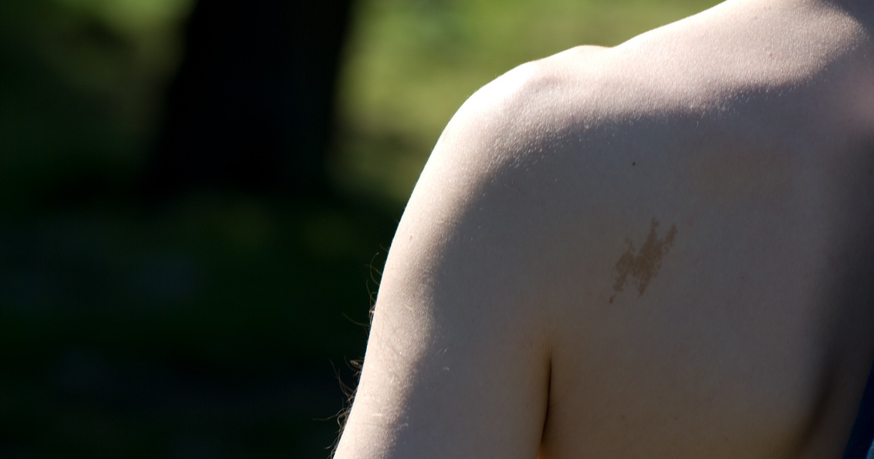 What Are Birthmarks And Why Do We Get Them?