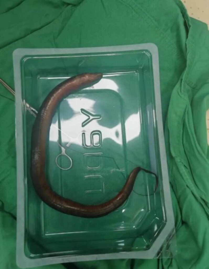 Man In China Finds Live Eel Inside His Abdomen