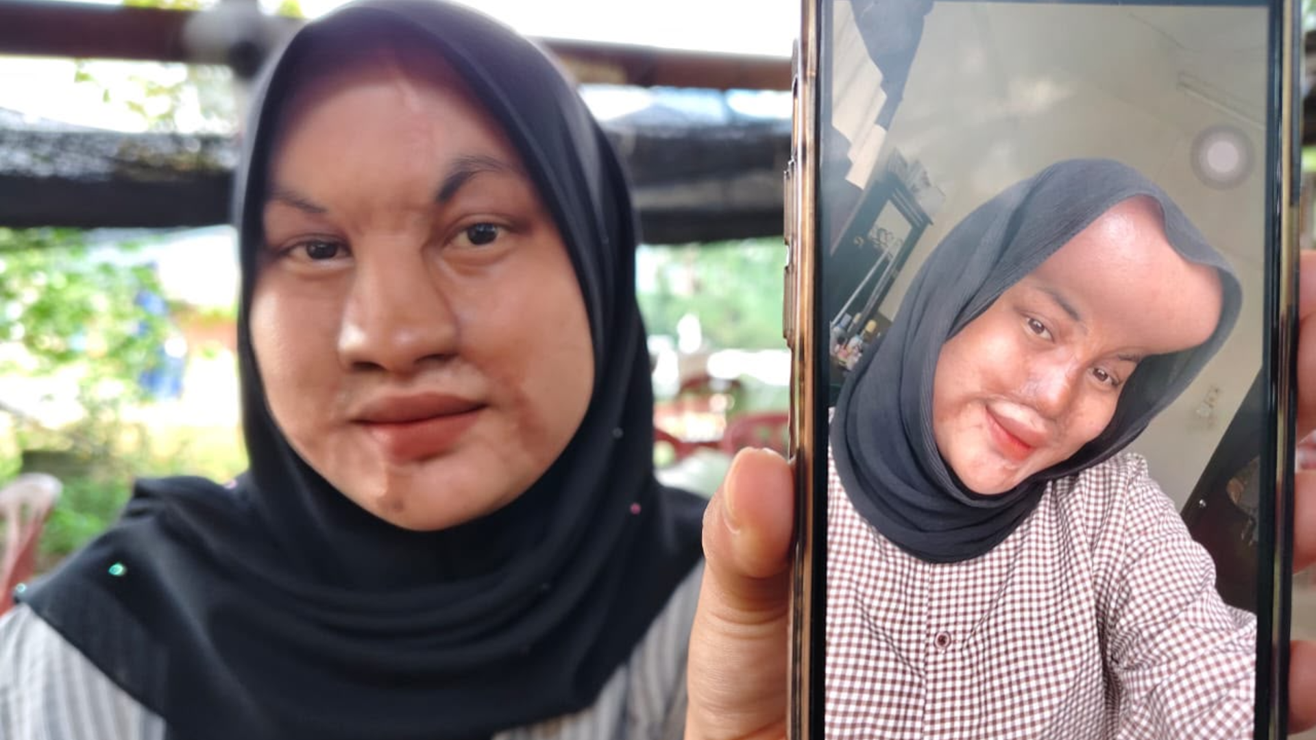 16 Tahun Selepas Insiden Cuka Getah, Wanita Jalani Pembedahan Wajah Kali Kelima