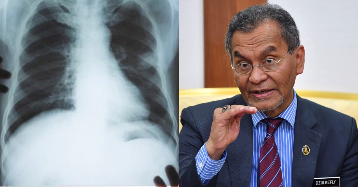 KKM Dedah Penyakit Paru-Paru Antara Tiga Punca Utama Rakyat Masuk Hospital & Maut Di Malaysia